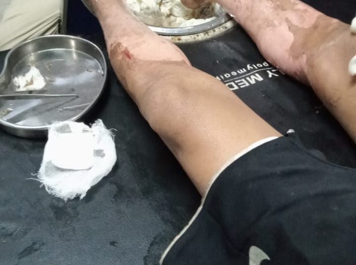 Kebakaran Rumah di Gelumbang Terdapat Tiga Orang Alami Luka Terbakar